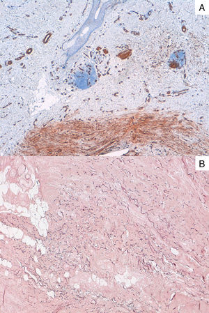 A, Immunohistochemistry showing diffuse staining of the tumor cells with smooth muscle actin (SMA). Stain for SMA, original magnification×40. B, Histochemical stain with orcein showing an increase in fragmented reticular fibers. Orcein, original magnification×100.