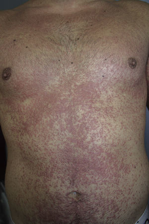 Erythematous maculopapular rash on the trunk.