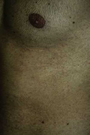 Lesions of lesser intensity similar to those of the previous rash. Reactivation after patch tests.