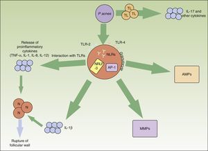 Inflammatory pathways involved in the pathogenesis of acne vulgaris. Propionibacterium acnes can interact directly with T lymphocytes and favor the release of inflammatory cytokines such as IL-17. In addition, synthesis of other inflammatory cytokines is favored through the TLR-2 and TLR-4 receptors of the perifollicular inflammatory cells. The NRLP3 inflammasome also plays an important role in the production of IL-1β. The release of all these proinflammatory cytokines into the extracellular medium leads to the inflammatory-cell-mediated rupture of the follicular wall. Pacnes also induces an increase in several matrix metalloproteinases through the transcription factor activator protein 1. These enzymes play an active role in tissue destruction and scarring. Finally, the bacteria are capable of causing the inveterate activation of antimicrobial peptides that perpetuate the inflammatory microenvironment. AMP indicates antimicrobial peptide; AP, activator protein; IL, interleukin; MMPs, matrix metalloproteinases; N, neutrophil; NLR, NOD-like receptor; P acnes, Propionibacterium acnes; TL, T lymphocyte; TLR, toll-like receptor; TNF, tumor necrosis factor.