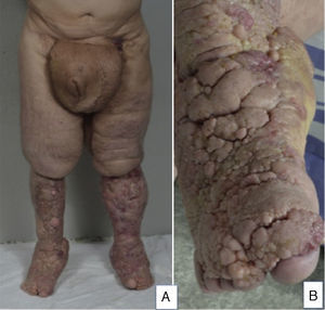 A, Marked bilateral lymphedema. B, Detail of the dorsum of the right foot.