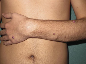 Multiple erythematous-violaceous tumors on the left upper arm and forearm in a linear, zosteriform pattern.