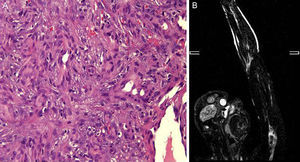 A, Histology showing the vascular proliferation of epithelioid endothelial cells with a solid pattern lining vascular spaces. Hematoxylin and eosin, original magnification ×40. B, Magnetic resonance angiography image of the arteriovenous malformation in the left upper limb, showing occlusion of the proximal humeral artery.