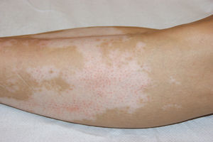 Small erythematous papules limited to an achromic macule of vitiligo on the patient's leg.