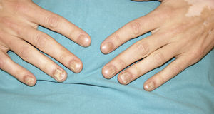 Nail dystrophy in the form of trachyonychia with longitudinal ridges.