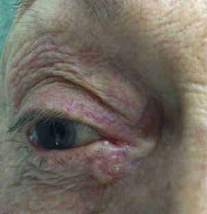 Basal cell carcinoma at the medial canthus.