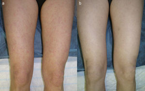 A. Erythematous papules on the lower limbs. B. Reduction in the number, intensity, and inflammation of the lesions 6 months after the addition of quinacrine 100 mg/d to the treatment regimen.