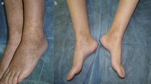 A. Purpuric papules on the lower limbs. B. Significant improvement after 3 months of quinacrine 100mg/d.