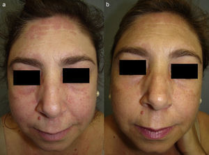 A. Heliotrope erythema and infiltrated pink plaques on the forehead, cheeks, and nasolabial folds. B. Significant improvement 6 months after the addition of quinacrine 100mg/d to the regimen.