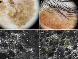 A, Dermoscopic image of a lesion of 3 years duration on the cheek of a 72-year-old woman. Dark brown rhomboidal structures are observed on a large part of the lesion (yellow arrows). B, CRM image showing irregular junction broadening with atypical cells (yellow arrows). C, Dermoscopic image of a supraciliary lesion of 10 years duration in a 50-year-old woman. Asymmetric follicular pigmentation (yellow arrows) can be observed. D, CRM image showing areas (yellow boxes) with an increased density of dermal papillae with polycyclic and geometric outlines that are named polycyclic papillary contours (also known as bulbous projections).