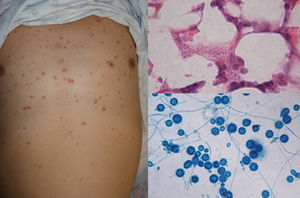 Papular lesions in a patient with disseminated cutaneous histoplasmosis and AIDS. Intracellular yeast forms in biopsy sample (hematoxylin-eosin, original magnification ×100) and direct examination of needle-shaped Histoplasma capsulatum conidia (lactophenol cotton blue, original magnification ×40).