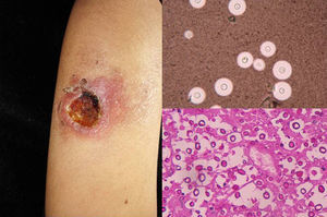 Cutaneous ulcer associated with a neural infection in a patient with cryptococcosis and AIDS. Encapsulated Cryptococcus neoformans yeasts (India ink, original magnification ×40) and yeast forms in biopsy sample (periodic acid-Schiff, original magnification ×40).