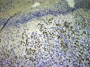 Nuclear positivity for human herpes virus 8 (hematoxylin–eosin staining, original magnification ×20).