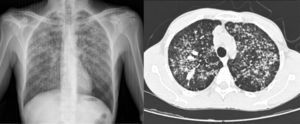 Chest X-ray and high-resolution computed tomography showing widespread bilateral reticulonodular opacities.