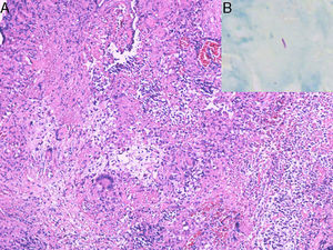 (A) Biopsy of the perianal lesion showing caseous necrosis and a granulomatous inflammatory process. Hematoxylin and eosin, original magnification ×40. (B) Positive bacilloscopy for acid-alcohol-fast bacilli.