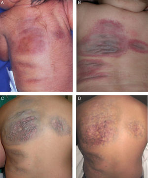 Clinical course of the lesions. A, Newborn: erythematous-violaceous plaques on the back. B, At 6 months of age: plaques with prominent vessels, erythematous borders, and a blue-violaceous center. C, Before laser treatment (7 years of age). D, After 10 sessions of combined pulsed dye and neodymium-doped yttrium aluminium garnet laser treatment (11 years of age).