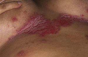 Erosive plaque in the submammary region, compatible with benign familial pemphigus.