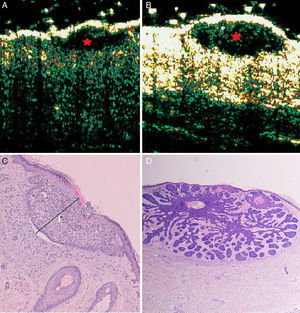 Superficial, nodular basal cell carcinoma. B-mode (20Mhz) longitudinal section. A, Heterogeneous subepidermal anechoic flat image with irregular but well-defined borders (red star), corresponding to a superficial subtype. B, Similar ultrasound appearance but with an oval shape, corresponding to a nodular subtype (red star). C and D, Histologic images of the tumors (hematoxylin-eosin×4).