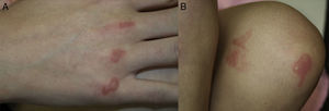 A, Tense clear fluid-filled blisters on well-delimited erythematous plaques on the metacarpophalangeal joints. B, Similar lesions on the left knee with an artifactual morphology.