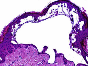 Subepidermal blister without inflammatory cells and with foci of reepithelialization (hematoxylin-eosin, original magnification ×4).