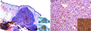A, Low-magnification view (hematoxylin-eosin). B, Immunohistochemistry with Melan-A. C, Immunohistochemistry with S100. D, Hematoxylin-eosin ×20. E, Immunohistochemistry with HMB45.
