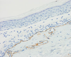 Immunohistochemical study with collagen iv, showing staining of the dermal part of the blister, thus demonstrating that the collagen is above the lamina densa, as well as the wall of dermal vessels (collagen iv ×200).