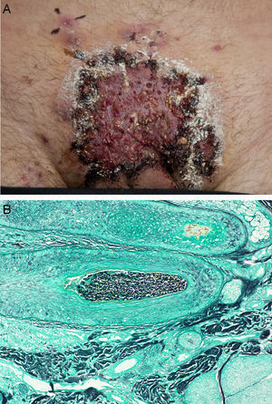 Case 1: (A) ulcerated plaque at the hypogastrium with satellite pustules. (B) Grocott staining showing fungal spores in the hair follicle.