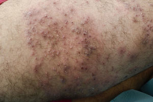 Case 2: erythematous plaques, follicular pustules and nodules in the right lower limb.
