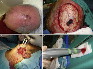 A, Merkel cell carcinoma on the scalp. B, Wide excision of the tumor. C and D, Technique used for a sentinel lymph node biopsy in the preauricular region.