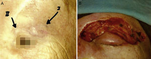 Merkel cell carcinoma removed with Mohs surgery. A, Tumor on the eyelid. B, Surgical defect after Mohs surgery.