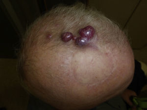 Local recurrence of Merkel cell carcinoma.