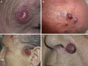 Merkel cell carcinoma tumors. A, Erythematous nodular lesion that is well defined, smooth, and shiny; telangiectases are evident on the surface. B, Poorly defined plaque with multiple nodules across its surface. C, Disseminated Merkel cell carcinoma. D, Small Merkel cell carcinoma.
