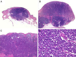 Histology. A and B, Panoramic view of a Merkel cell carcinoma. The tumor is well defined, unencapsulated, and nodular; hematoxylin-eosin, original magnification ×10. C, Localized tumor in the dermis. The cells are round, basophilic, and monomorphic; hematoxylin-eosin, original magnification ×100. D, Round, blue cells with scant cytoplasm, and finely granular chromatin condensation. Numerous mitotic figures are present; hematoxylin-eosin, original magnification ×400.