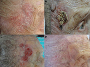 A, Large Bowen disease lesion on the right temple of a 95-year-old woman. The lesion was treated with 3 sessions of photodynamic therapy with methyl aminolevulinate and cleared completely within 3 months. B, The patient developed a crusted lesion in the same area 6 months after treatment. Recurrence was confirmed by biopsy following removal of the crust. C, Treatment with topical 5% imiquimod was started. D, The treatment resulted in complete clearance and no recurrences were detected during follow-up.