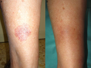 A, Bowen disease lesion that would have been difficult to treat surgically on the posterior surface of the left leg in an 80-year-old woman. B, Complete clearance of the lesion after 3 cycles of photodynamic therapy with methyl aminolevulinate. No evidence of sequelae or recurrence was detected during follow-up.
