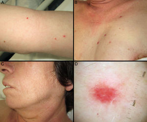 A and B, Violaceous, dome-shaped papules with a vascular appearance on the upper chest and arms. C, Hypertrichosis in the malar region. D, Dermoscopic image showing milky-red areas.