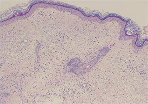 Edema associated with a moderate inflammatory infiltrate of lymphocytes and neutrophils in the superficial dermis, with occasional images of leukocytoclasia. No extravasation of red blood cells is observed, nor the presence of hemosiderophages or lesions of fibrinoid necrosis in the vessel walls. Hematoxylin and eosin, original magnification×20.