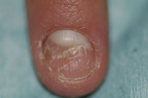 Brittle appearance of the nail of the left index finger, with a central depression larger than that seen in pitting.