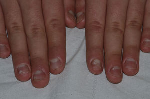 Rough and brittle surface of all the nail plates, although less evident in the fifth fingers. Oil spots and pinpoint leukonychia are visible.