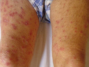 Disseminated herpes zoster lesions involving both thighs of an immunocompromised patient.