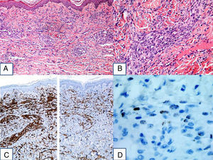 A, Hematoxylin-eosin, original magnification×10. B, Hematoxylin-eosin, original magnification×40.C, Immunohistochemistry for CD31 and D2-40. D, Positive for human herpesvirus 8.