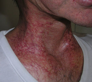 Chronic radiodermatitis with marked skin atrophy and numerous telangiectases.