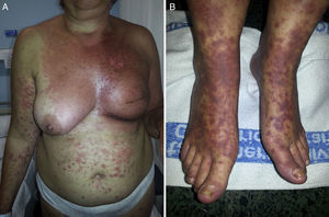 A, Erythema multiforme initially confined mainly to the field irradiated for breast cancer. B, The eruption later spread, forming atypical target lesions.