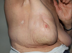 Radiation-induced morphea in a patient with a history of cancer in the right breast. Photograph provided by Dr. José Antonio Avilés Izquierdo.