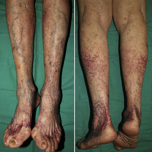 Clinical presentation of Patient 2 (cutaneous collagenous vasculopathy). Red wine–colored telangiectasias on both lower limbs in a patient with signs of venous insufficiency.