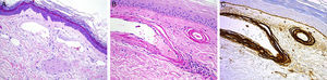 Histology study for Patient 2 (cutaneous collagenous vasculopathy). A, Vessels with slightly thickened walls in the upper dermis (hematoxylin-eosin, original magnification, ×20). B, Perivascular deposition of material that stained with periodic acid–Schiff diastase (×40). C, Immunohistochemistry revealed strongly positive results for collagen IV, thus indicating reduplication of the basement membrane (×40).