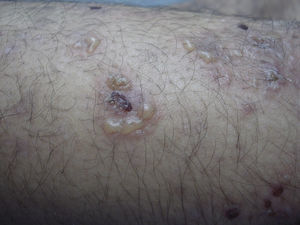 Blisters containing serum arranged in a rosette pattern with a central crust on erythematous skin.