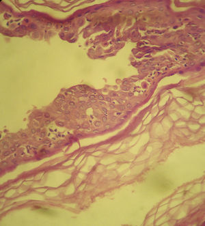 Intraepidermal blister with suprabasal and intermediate layer acantholysis and numerous acantholytic cells in the interior. Also visible are clusters of neutrophils and eosinophils between the acantholytic keratinocytes of the stratum spinosum (hematoxylin-eosin, original magnification ×400).