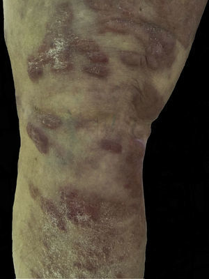 Coalescent erythematous-squamous plaques and blisters measuring 1 to 3cm on the lower limbs.