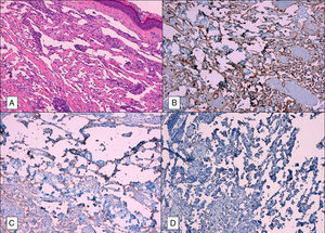 A, Anastomosed, small-caliber vascular channels with no content dissecting collagen bundles (hematoxylin-eosin, original magnification, ×10). B, Expression of CD34 (×10). C, Expression of D2-40 (×10). D, Expression of HHV-8 (×10).